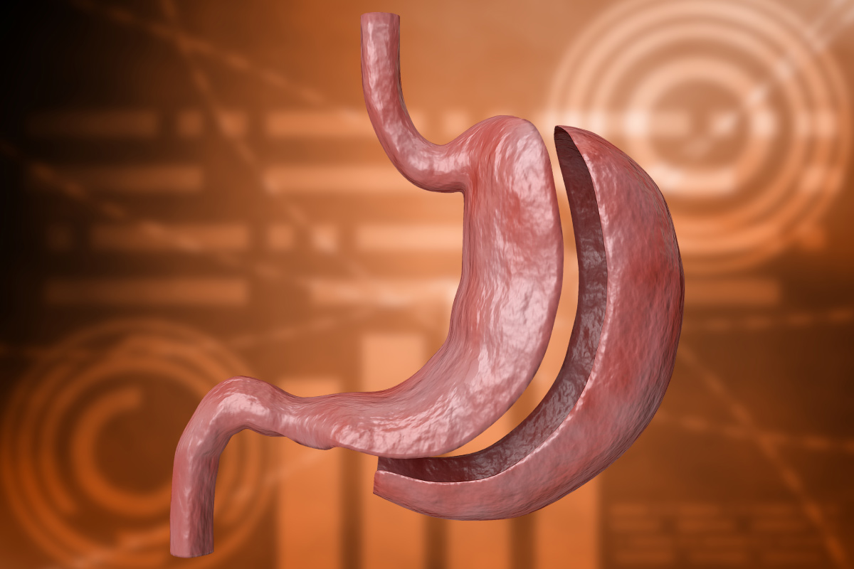 bariatric surgery for weight loss