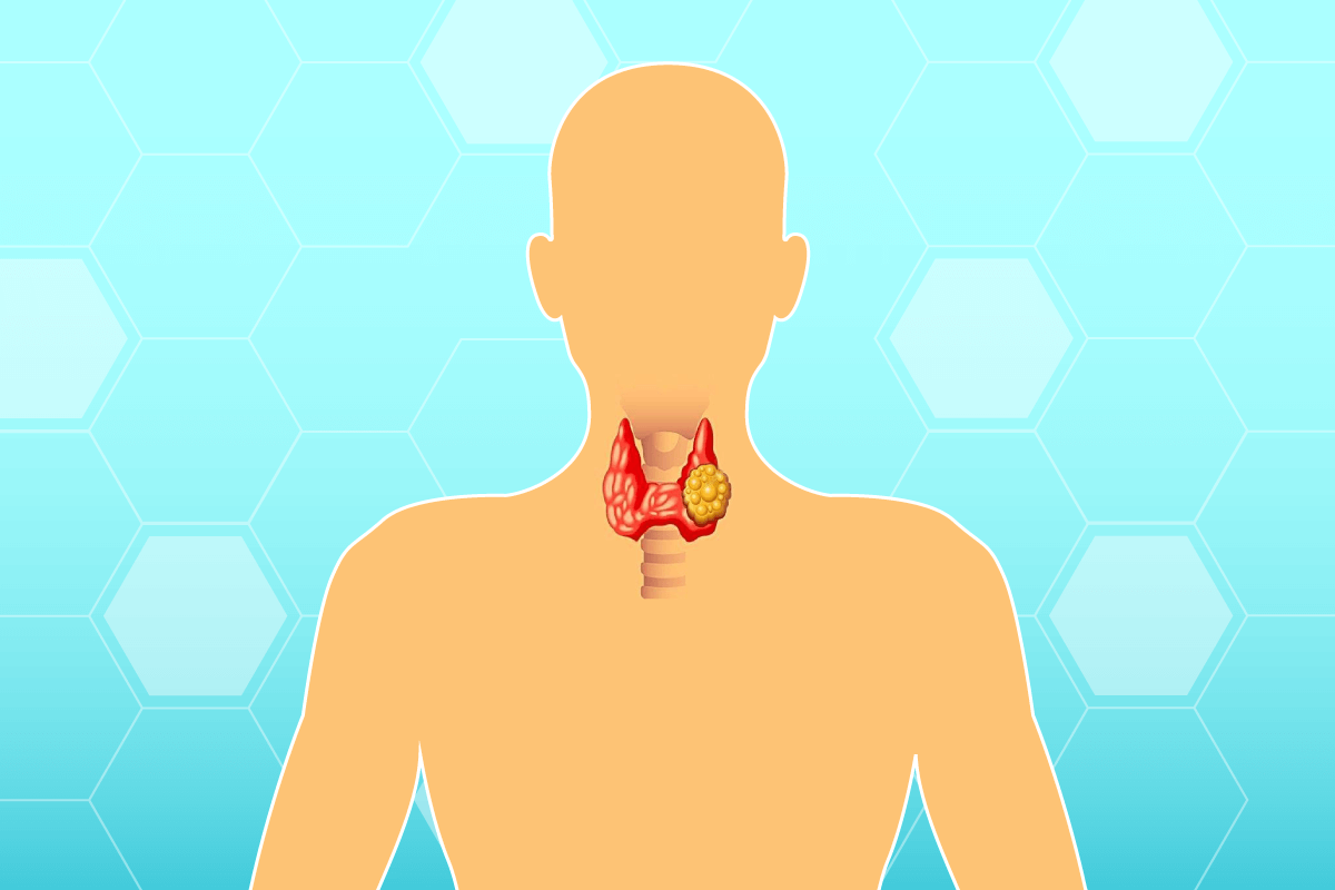 Lumps in the thyroid