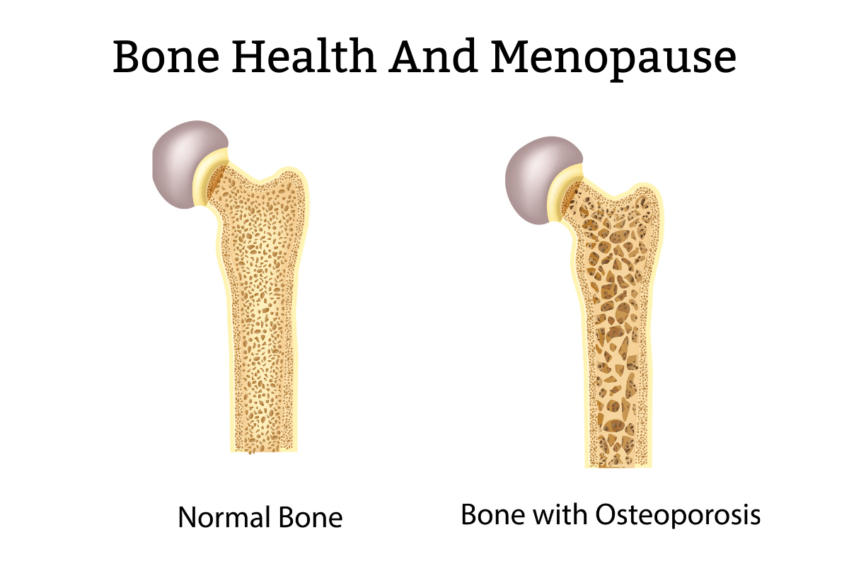 Bone health and menopause