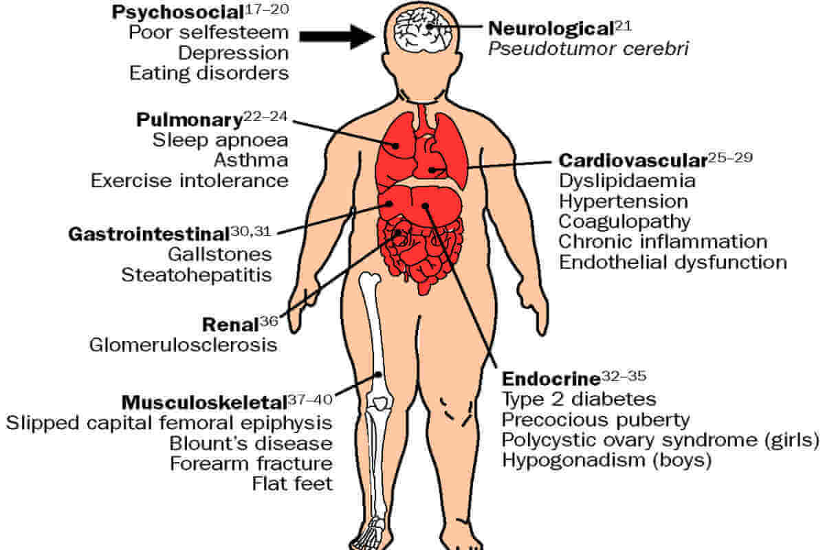 childhood obesity effects