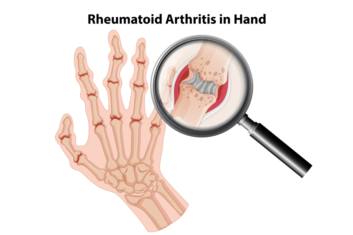 Rheumatoid Arthritis in hand