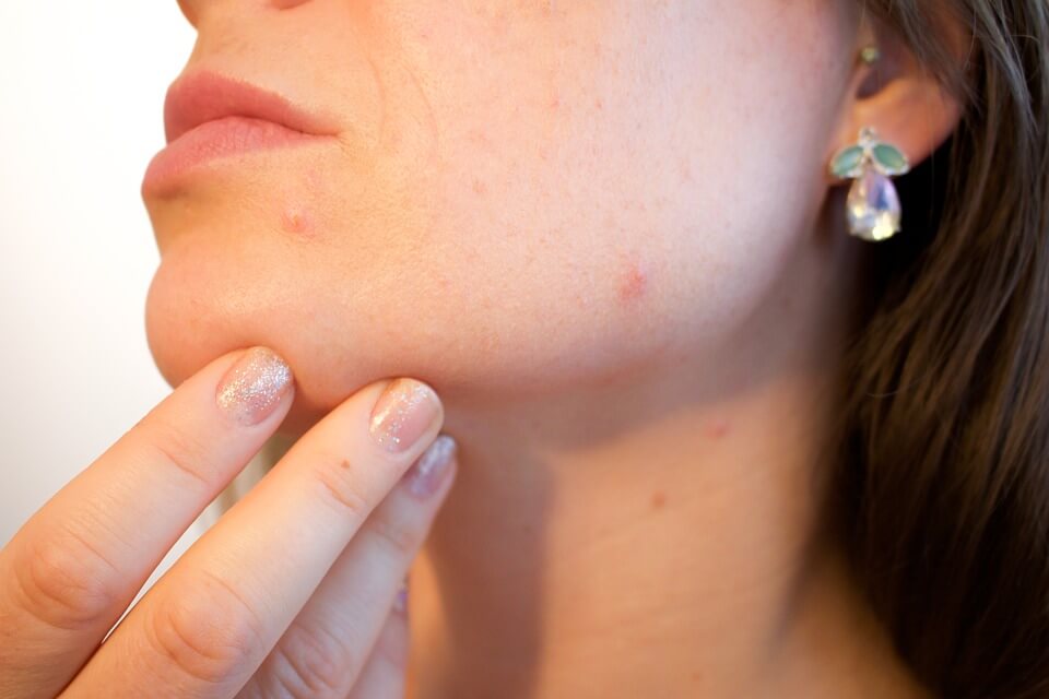 Women with PCOS PCOS symptoms - Acne