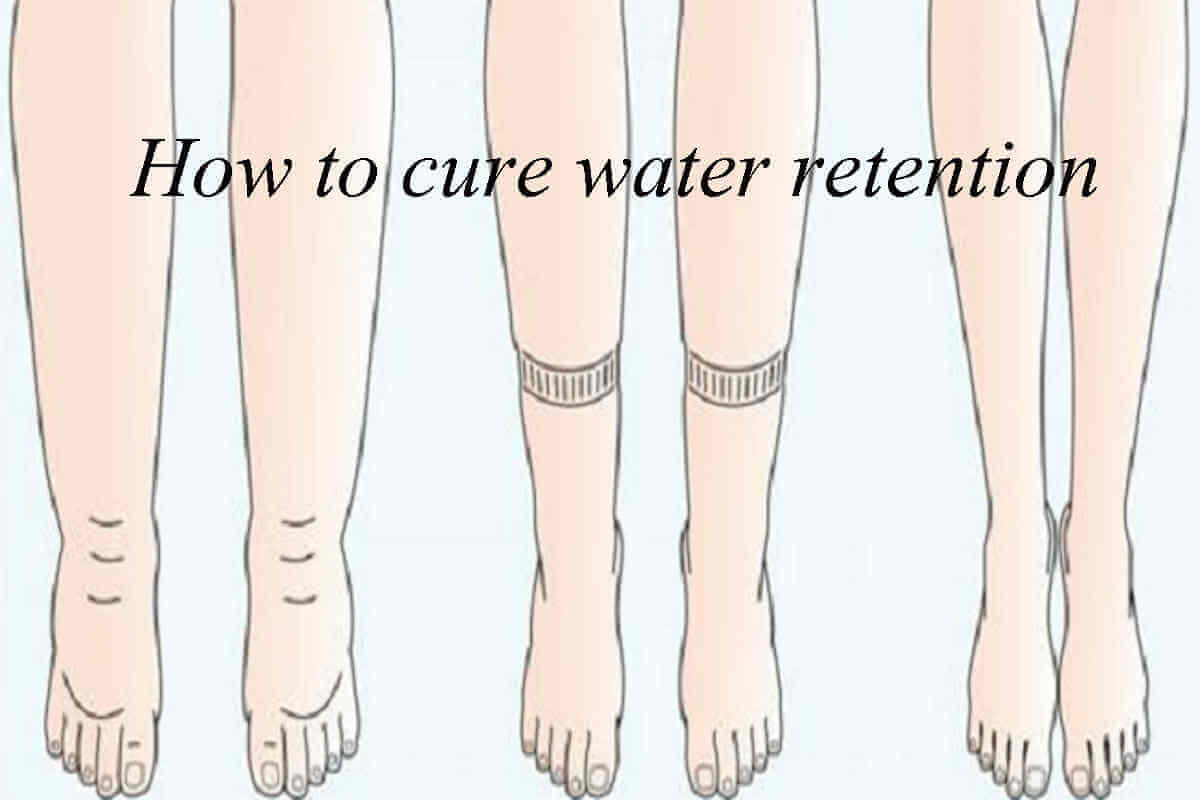 Water Retention Causes, Symptoms and Remedies Possible