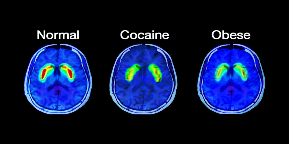 Know Why Sugar Addiction Is Worse Than Cocaine Addiction?