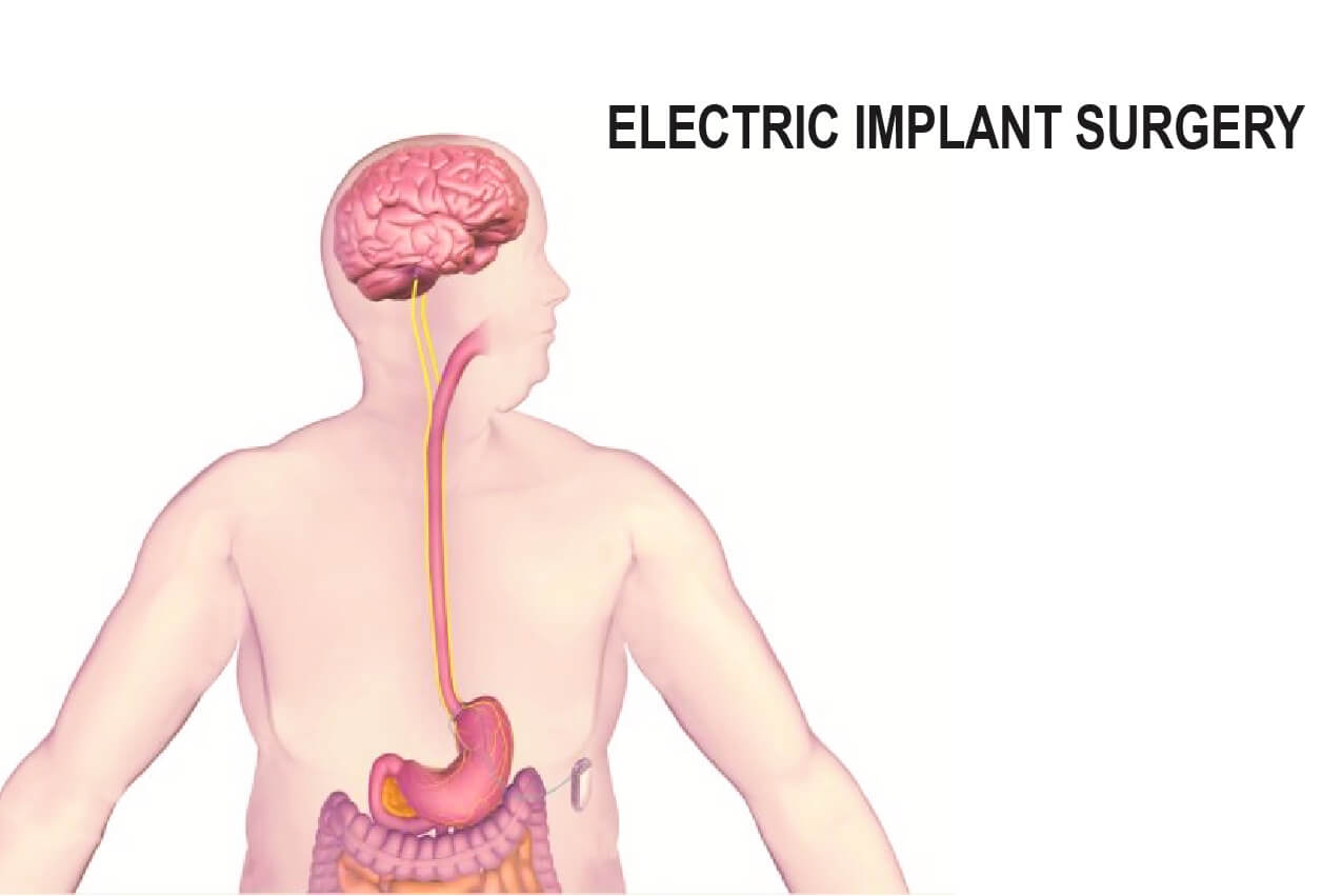 Electric Implant Weightloss Surgery Electric Implant Weightloss Surgery